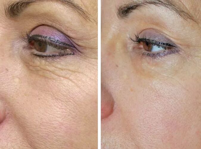 Feldlaser vor und nachher